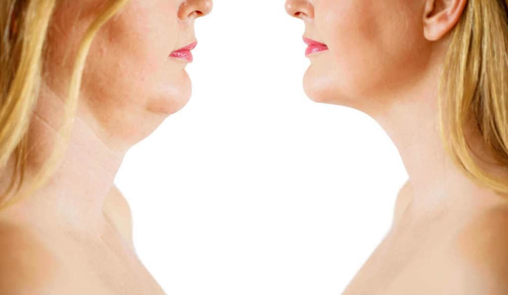 Double Chin treatment Beckton before and after results