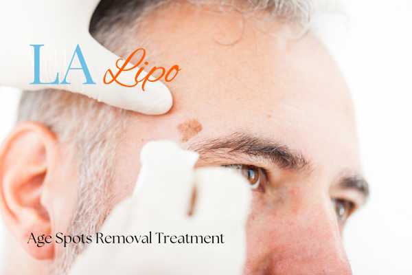 What Are the Most Effective Treatments for Age Spots Beckton?