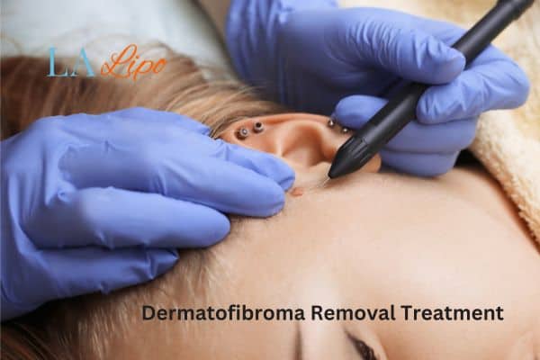Dermatofibroma Removal Treatment Beckton