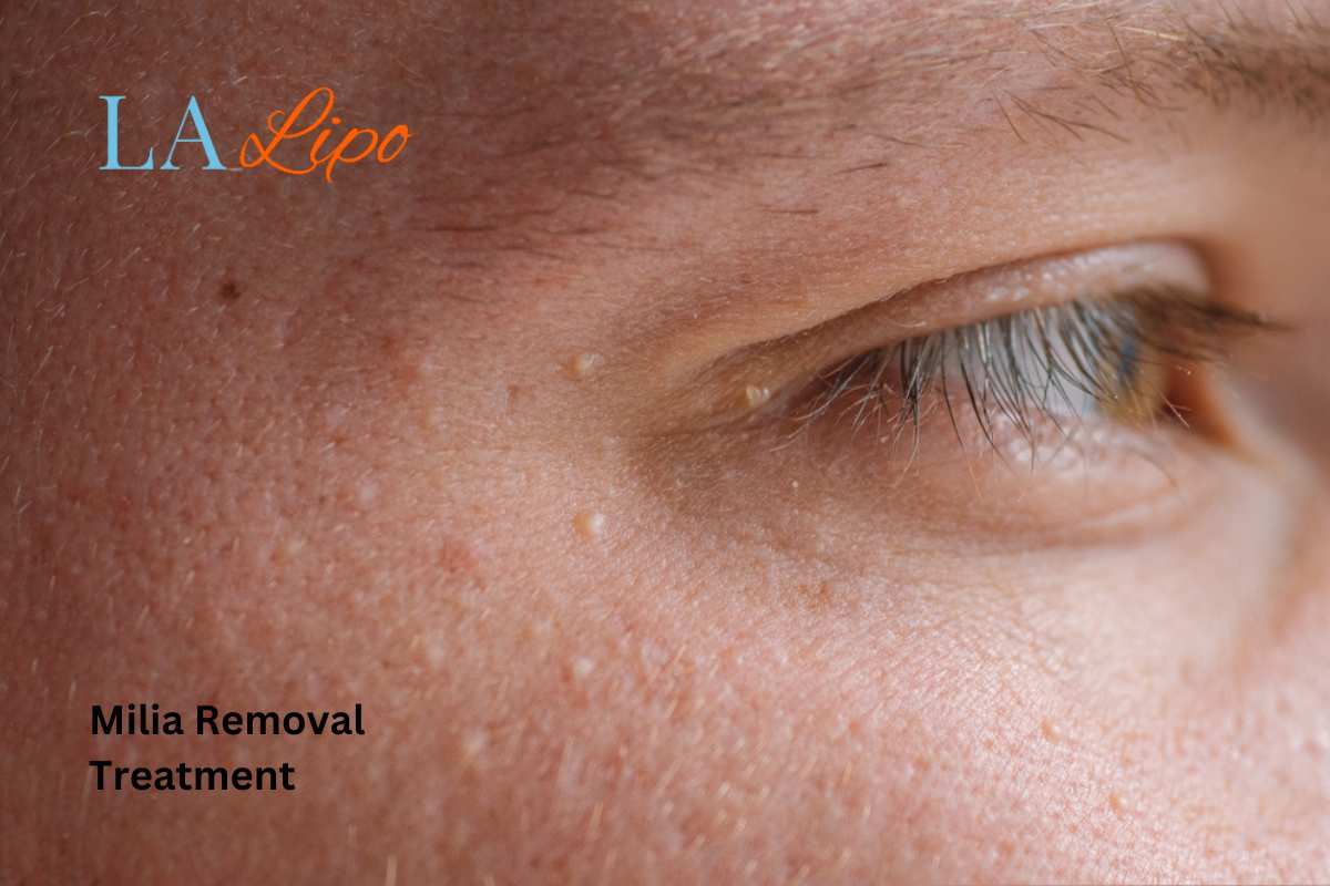 Cryopen Milia Removal: Is It the Easiest and Safest Option Beckton?