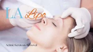 Woman receiving Actinic Keratosis Removal Treatment Beckton