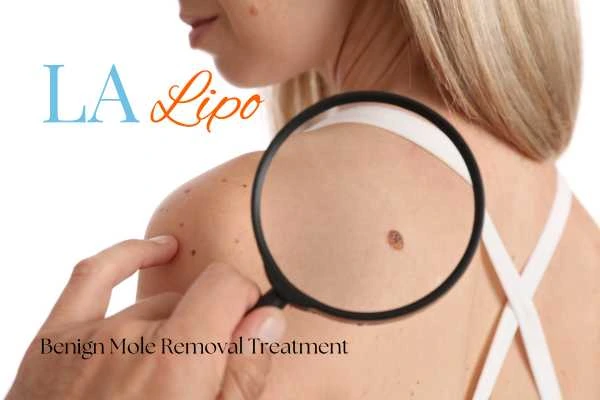 Woman having her inspection of blemish before mole removal Beckton