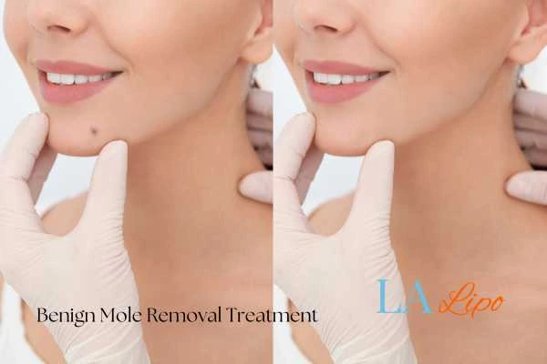 woman's before and after mole removal Beckton results