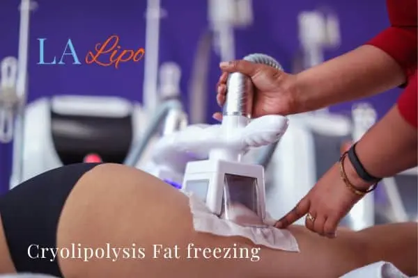 women getting fat freezing Beckton