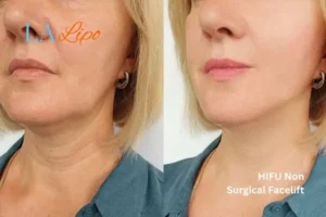 hi-fu for wrinkles Beckton before and after results