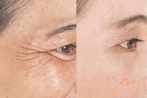 Before and after results of woman - HI-fu wrinkles reduction treatment Beckton