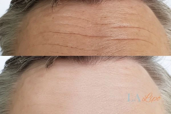 results of HIFU Beckton on mans forehead to help reduce lines and wrinkles