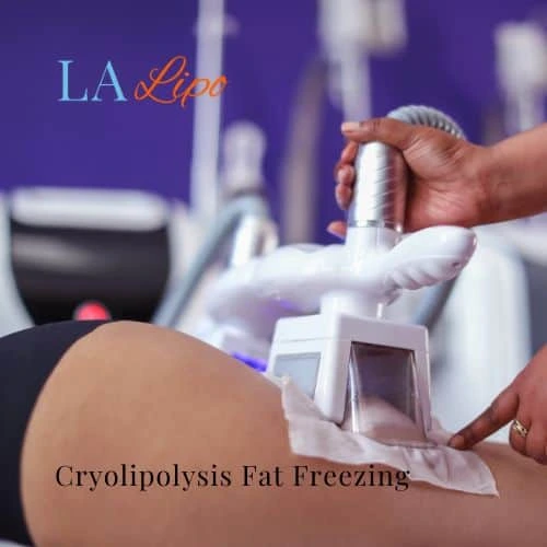 fat freezing - Cryolipolysis Beckton