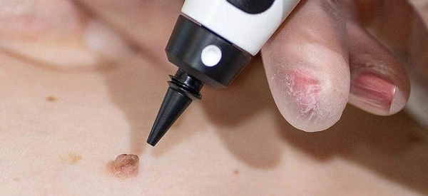 skin tag removal using cryopen Beckton