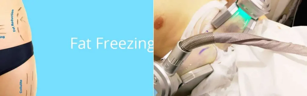 Fat freezing Beckton on multiple areas of the body