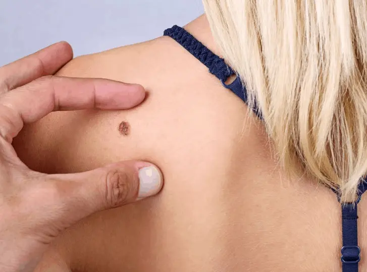 woman having mole removal Beckton consultation before treatment.