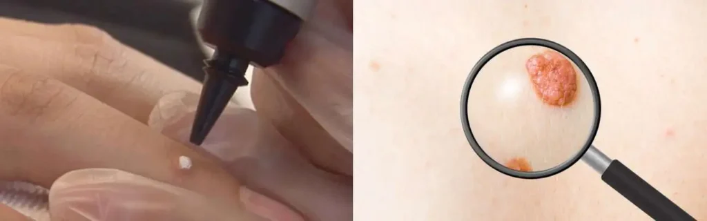 Cryopen for mole removal Beckton - speak to our team today!