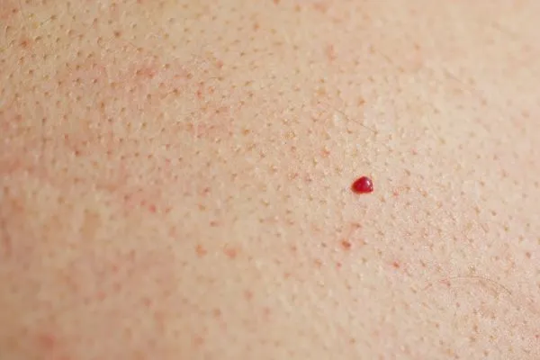 close up of a cherry angioma Beckton