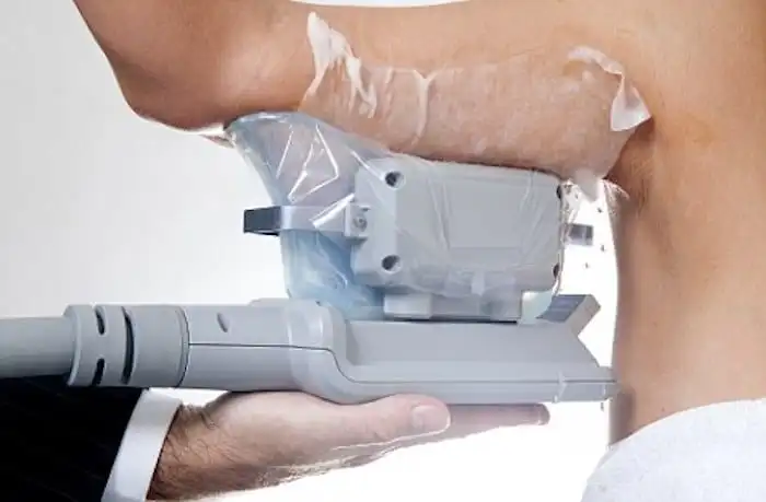 Picture of fat freezing Beckton on the upper arms.