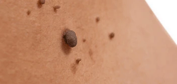 image of a skin tag Beckton