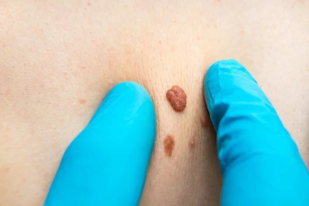 Consultant examining a skin tag Beckton