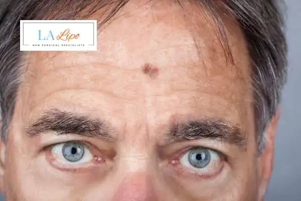 Solar Lentigo Removal Beckton image of man with mark on his forehead