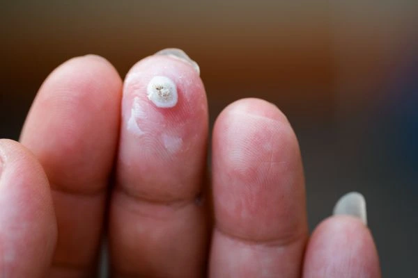 wart on person finger - cryotherapy to treat from LA LIPO Beckton