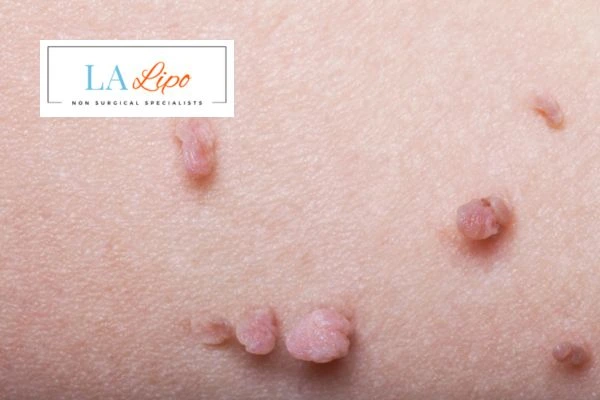 Does cryopen skin tag removal Beckton hurt? Find out now call our team today!