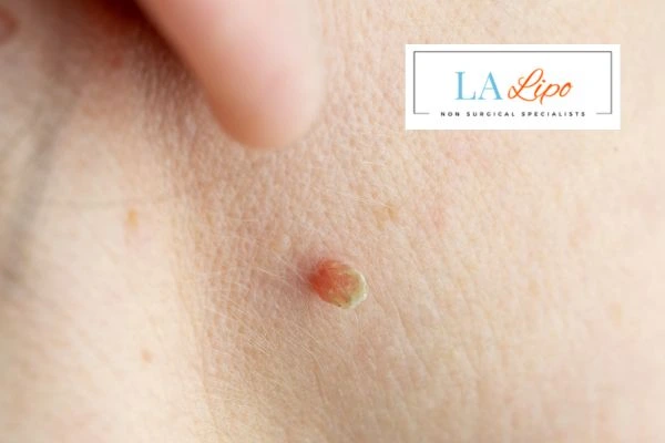 Book skin tag removal Beckton today speak to our team now!