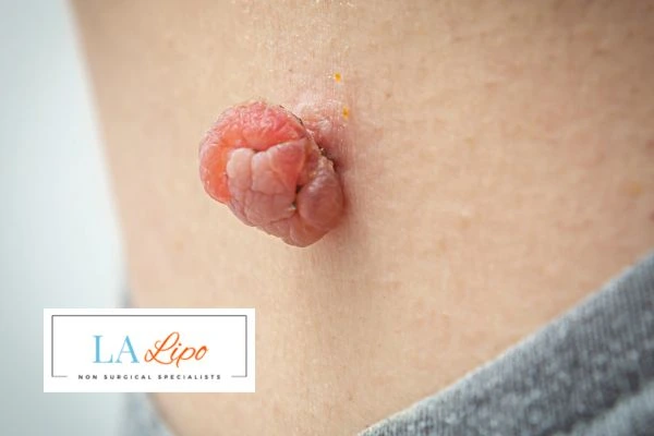 Interested in skin tag removal Beckton? Concerned about the pain? Find out more today!