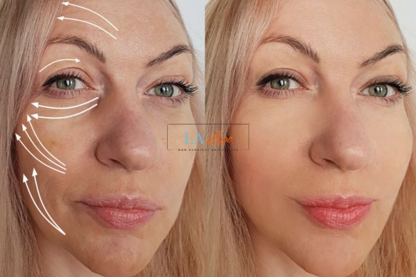 Morpheus 8 results Beckton face lift.