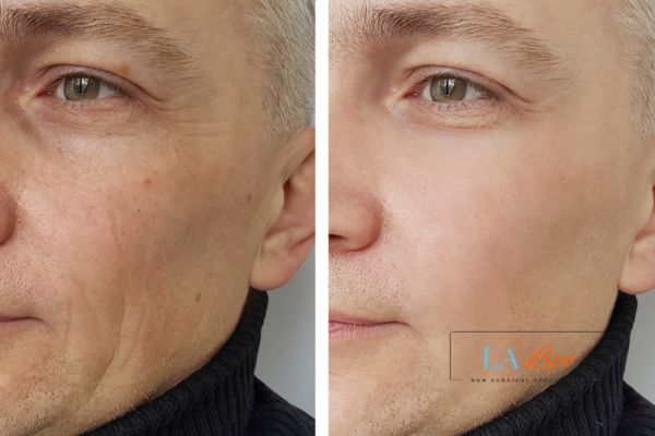 See the amazing results of Morpheus8 Treatment Beckton!