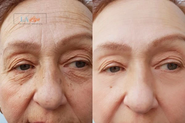 The powerful benefits of Morpheus8 Treatment Beckton - Call Our team today!