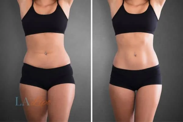 before and after results of non-surgical treatment to help a woman's body image and mental health Beckton