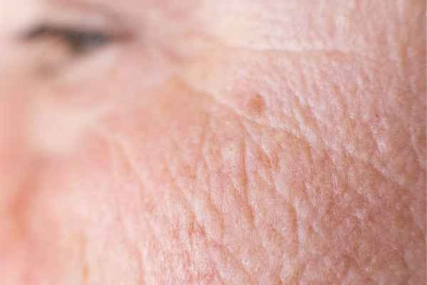 close up picture of a woman's face showing an age spot Beckton
