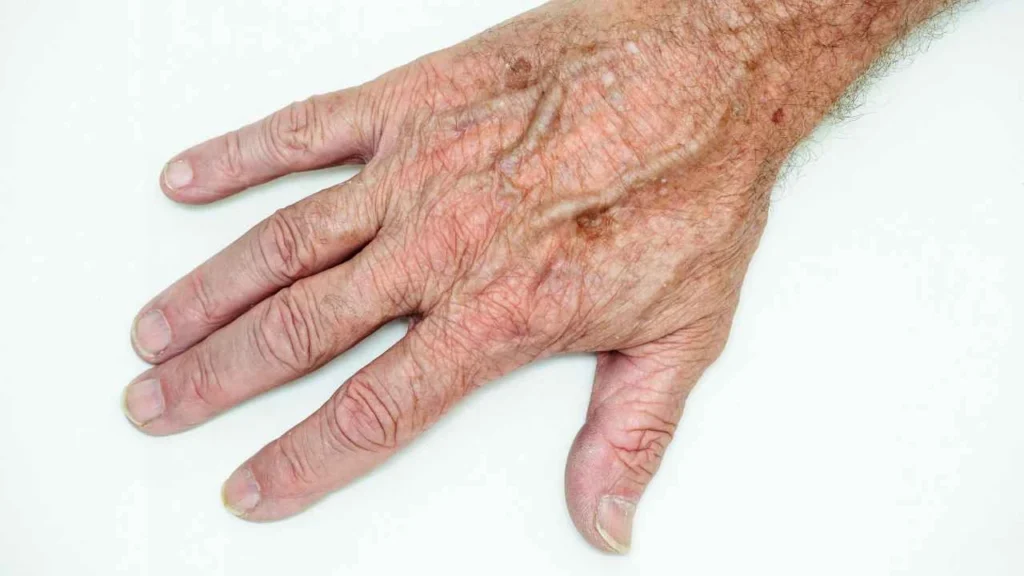 Male hand showing age spot Beckton
