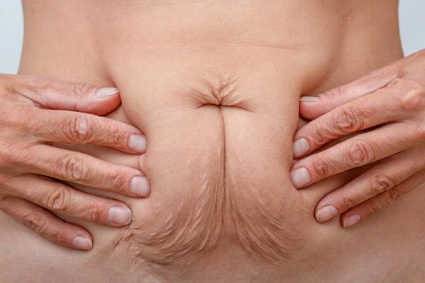 Should I Combine Diastasis Recti Treatment with Body Contouring for Better Results Beckton?
