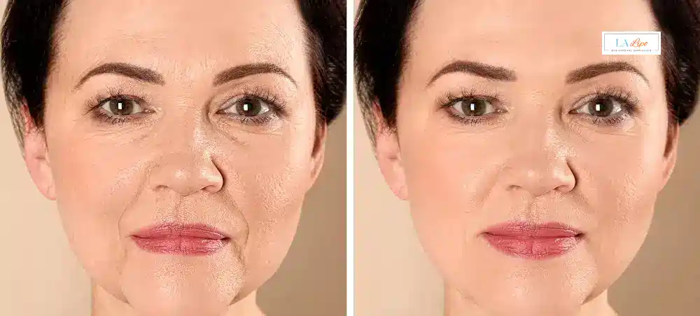 How Long Does It Take to See Results and How Long Do They Last Beckton?
