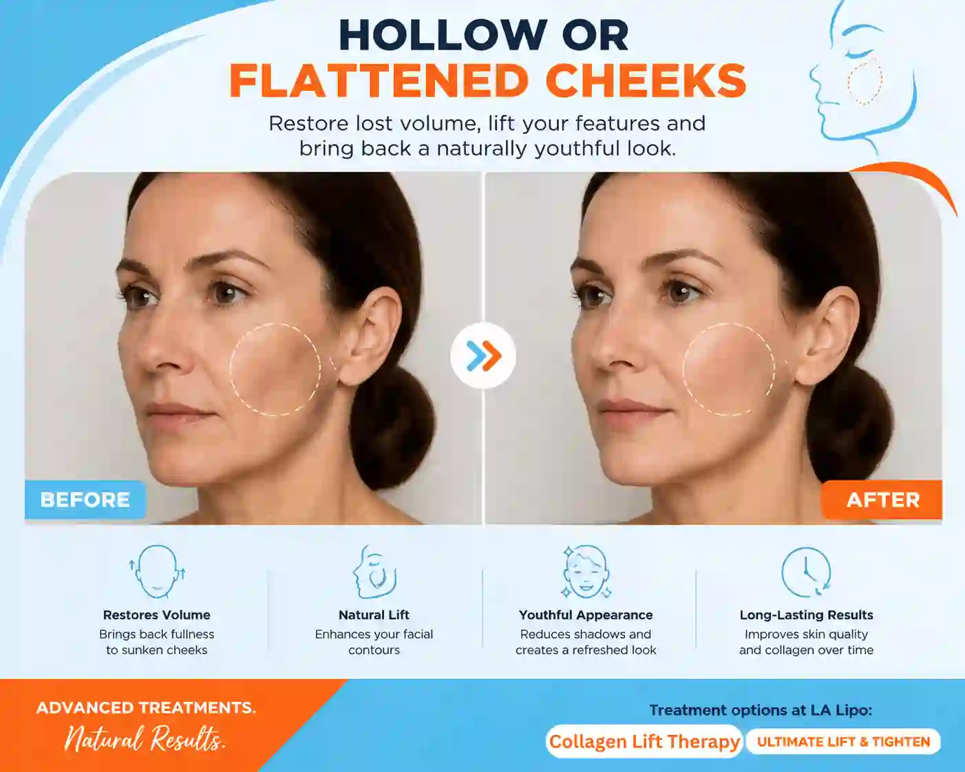 Sign #4: Hollow or Flattened Cheeks Beckton