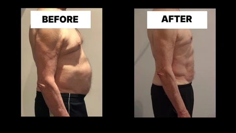 What Symptoms Can Diastasis Recti Cause in Men? Weak Core, Back Pain and Poor Posture Beckton